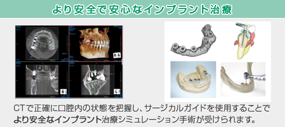 安全で安心なインプラント治療