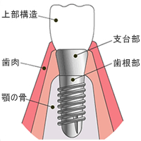 インプラントの構造