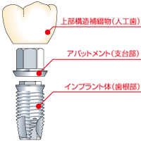 インプラントの構造