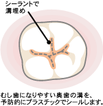 「六歳臼歯」に効果的