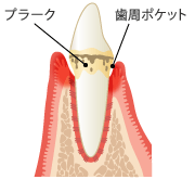 【歯肉炎】