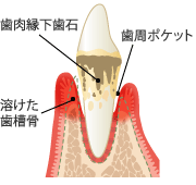 【歯周炎】