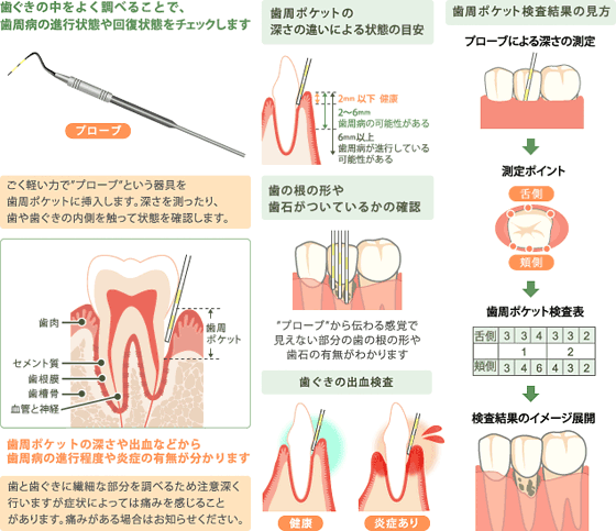 歯周ポケット検査