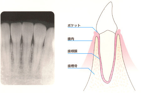 歯周病写真