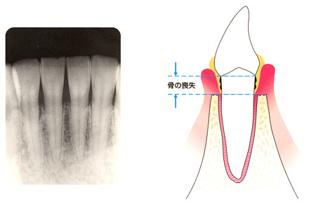 歯周病写真