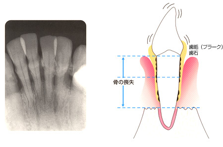 歯周病写真